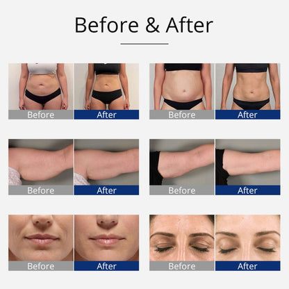 40K Cavitation & RF Body Sculpting Machine for Face and Body