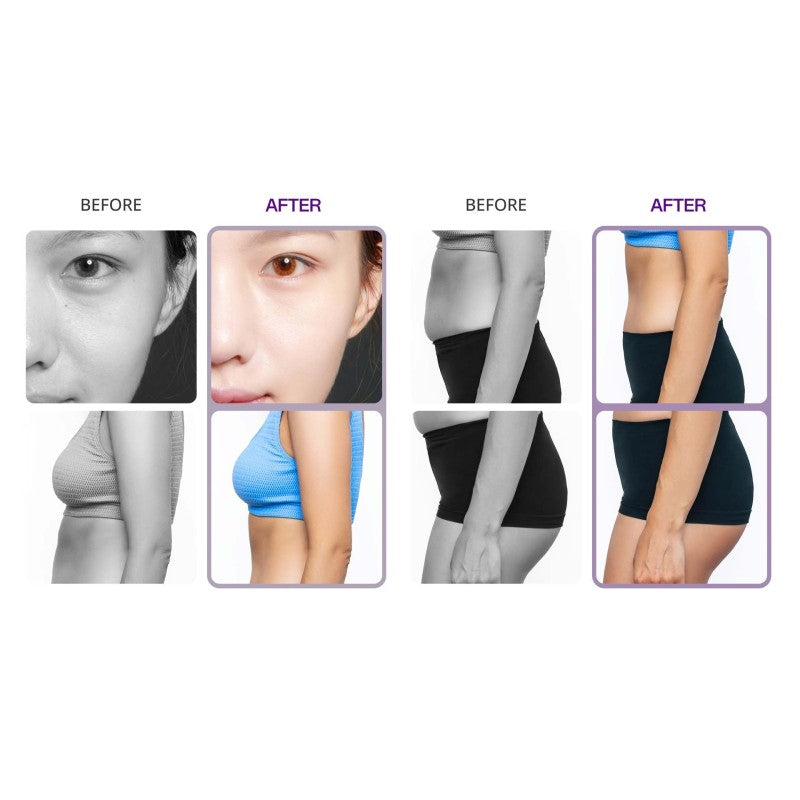 5-in-1 40K Ultrasonic Cavitation & RF Body Contouring Machine